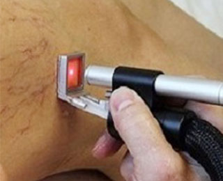Varicose veins laser